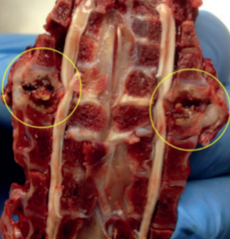 Figura 1 - Corte sagital da coluna vertebral. Observe a compressãodo abscesso vertebral na medula espinhal (Círculos amarelos). Fonte: Aitchison et al., 2014.