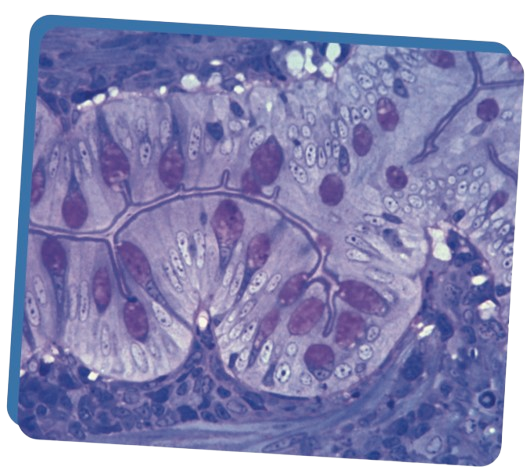 criptosporidiosis